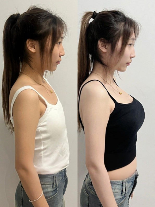 Tracy 豐胸前後對比