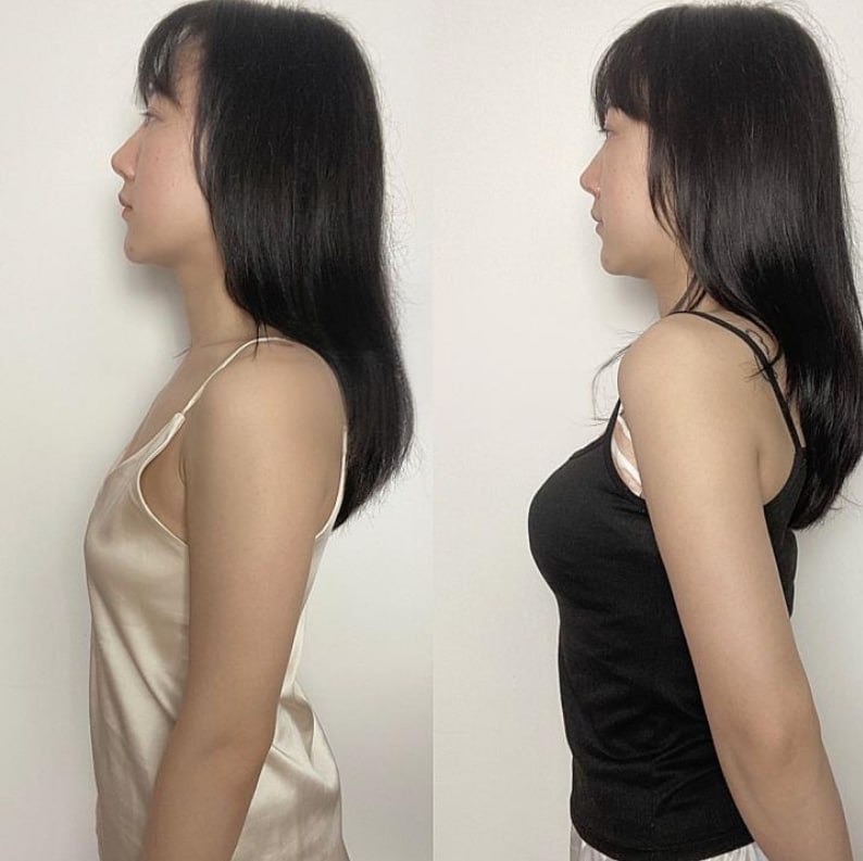 Winnie 豐胸前後對比